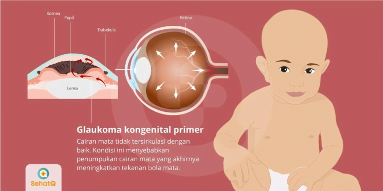 Glaukoma Pada Anak Dan Apa Yang Perlu Diketahui Orang Tua